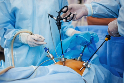 Chirurgie par cœlioscopie